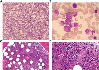 Case Report: Pathogenesis With a Rare RHOA A161E Mutation in a Patient With Angioimmunoblastic T-Cell Lymphoma